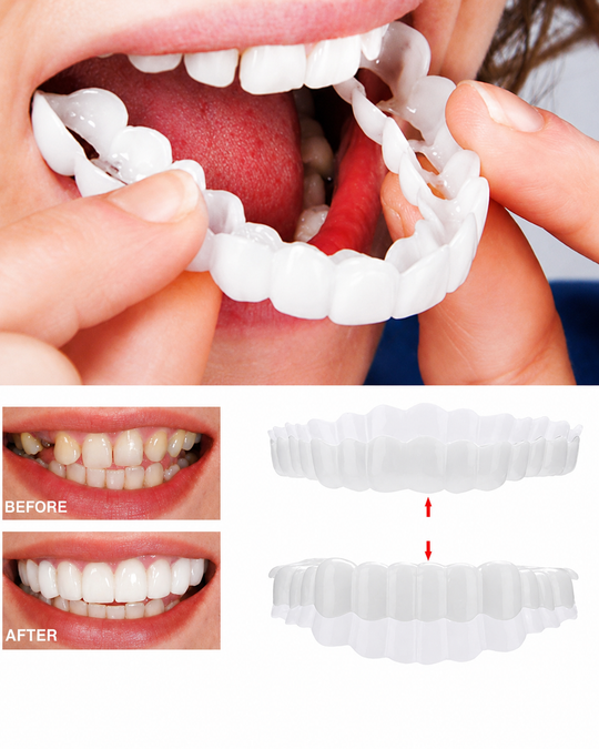 Over Smile Fineer Set voor Perfecte Glimlach