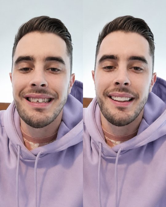 Over Smile Fineer Set voor Perfecte Glimlach